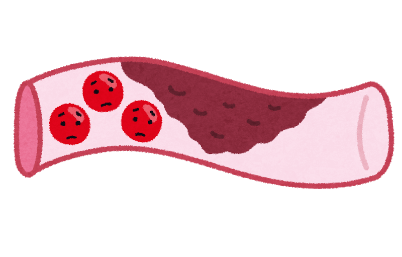 血栓イメージ